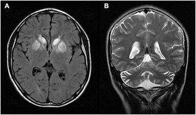 A Novel TTC19 Mutation in a Patient With Neurological, Psychological, and Gastrointestinal Impairment